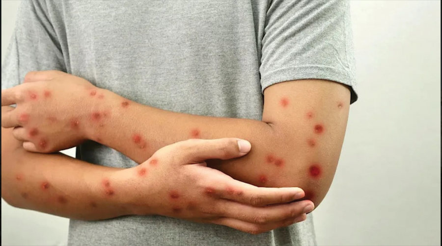 Three officials suspended after measles claims six lives in Khanewal 