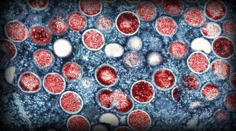 New mutating mpox strain speeds up transmission 