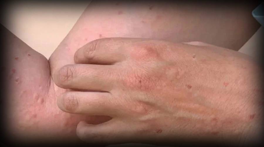 Third monkeypox case confirmed in KP