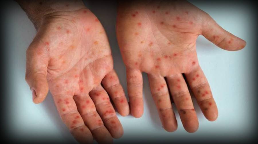 BHS fails to detect Mpox patient at Islamabad airport