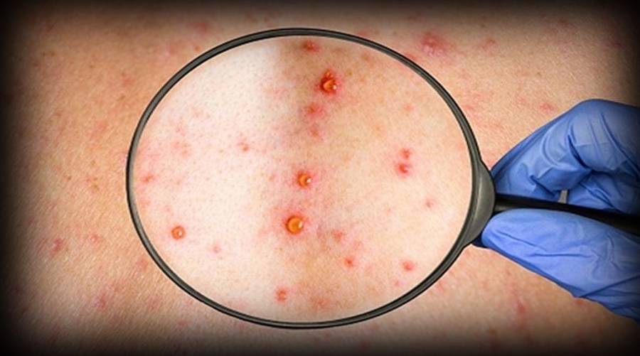 7th Monkeypox confirmed in Pakistan 