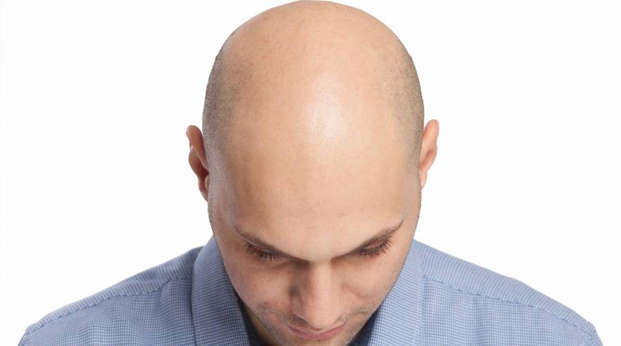 Hair follicle stem cell discovery may offer new hope for hair loss treatments.